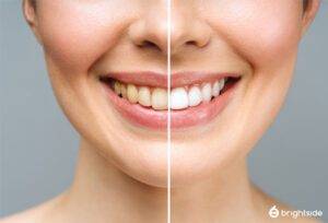 Close up image of a smile that shows difference between stained teeth and whitened teeth