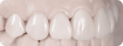 Dental Veneers