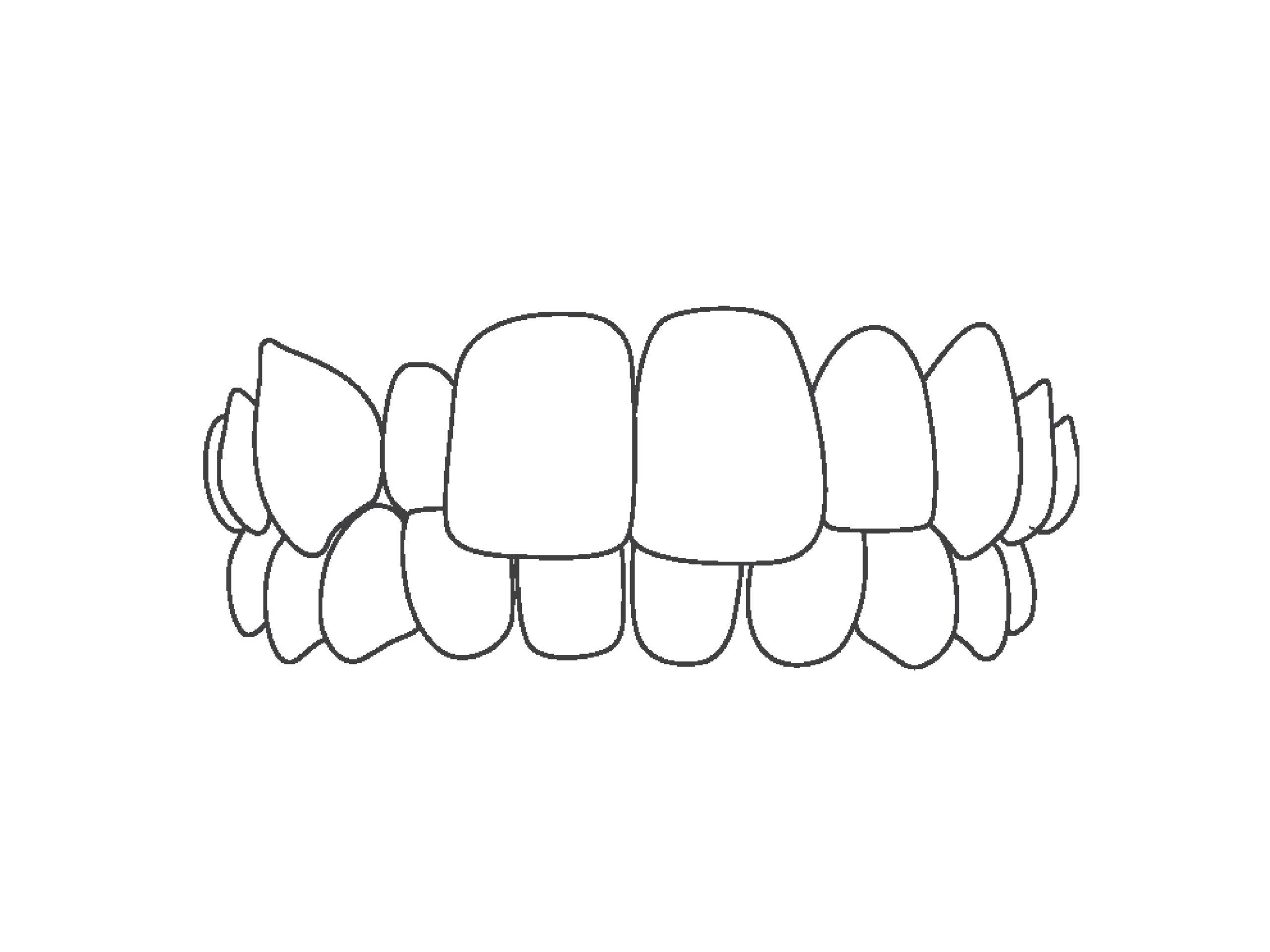 Line art of crossbite