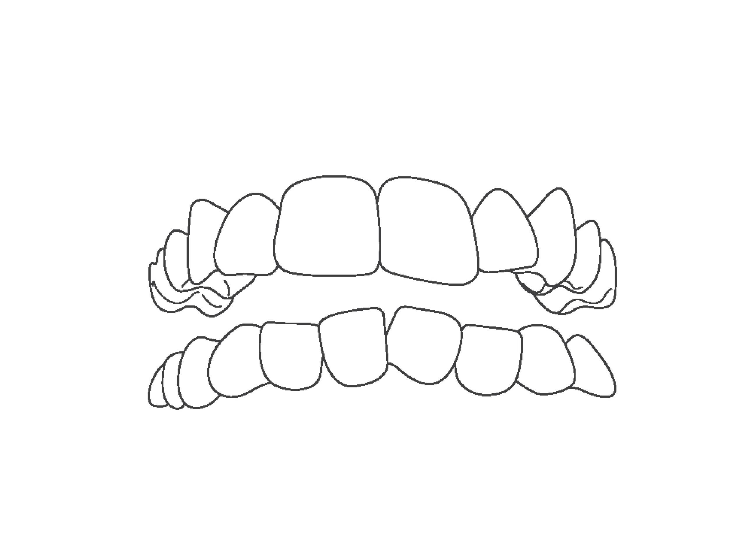 Line art of crowded teeth