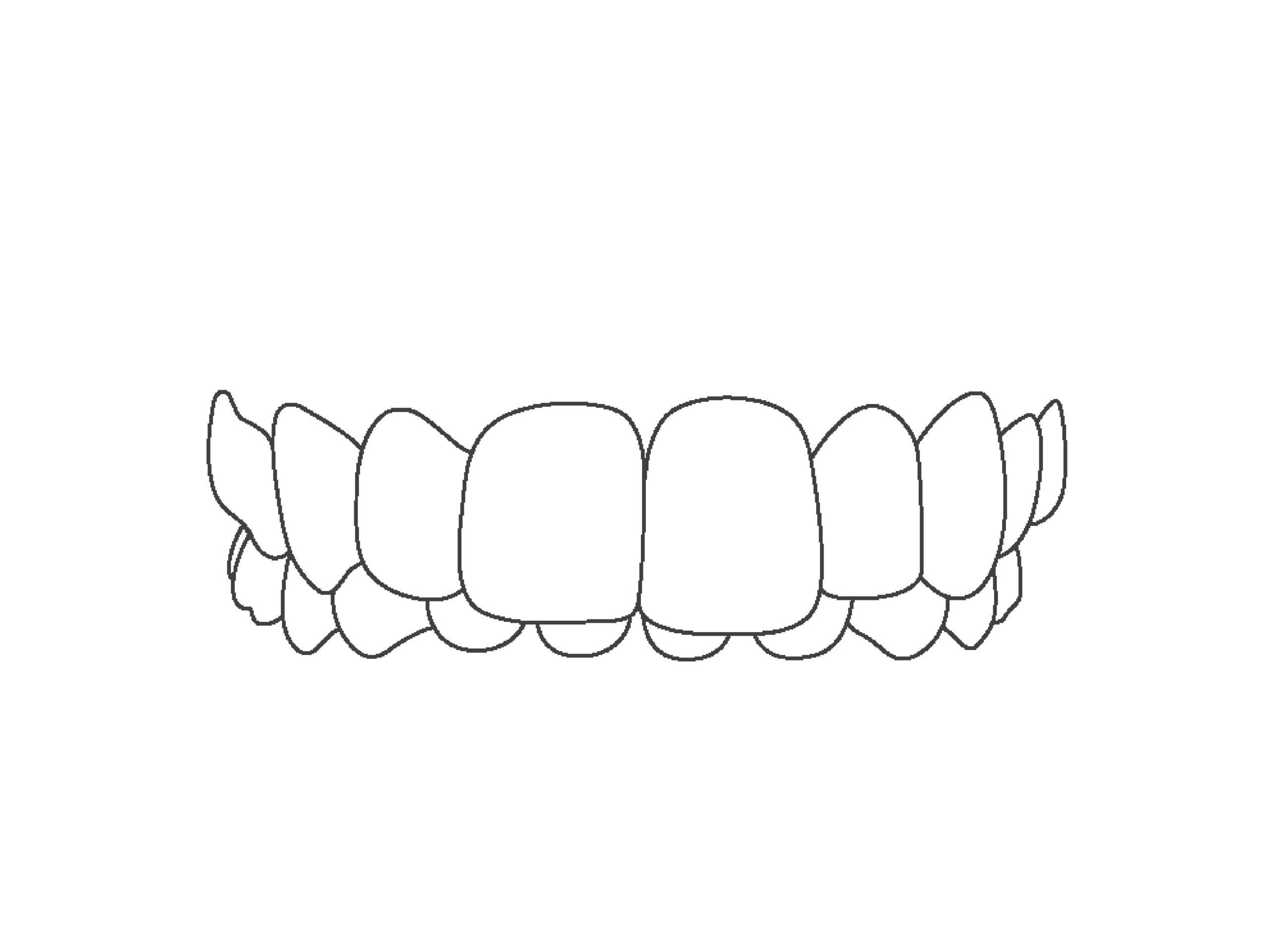 Line art of deep bite