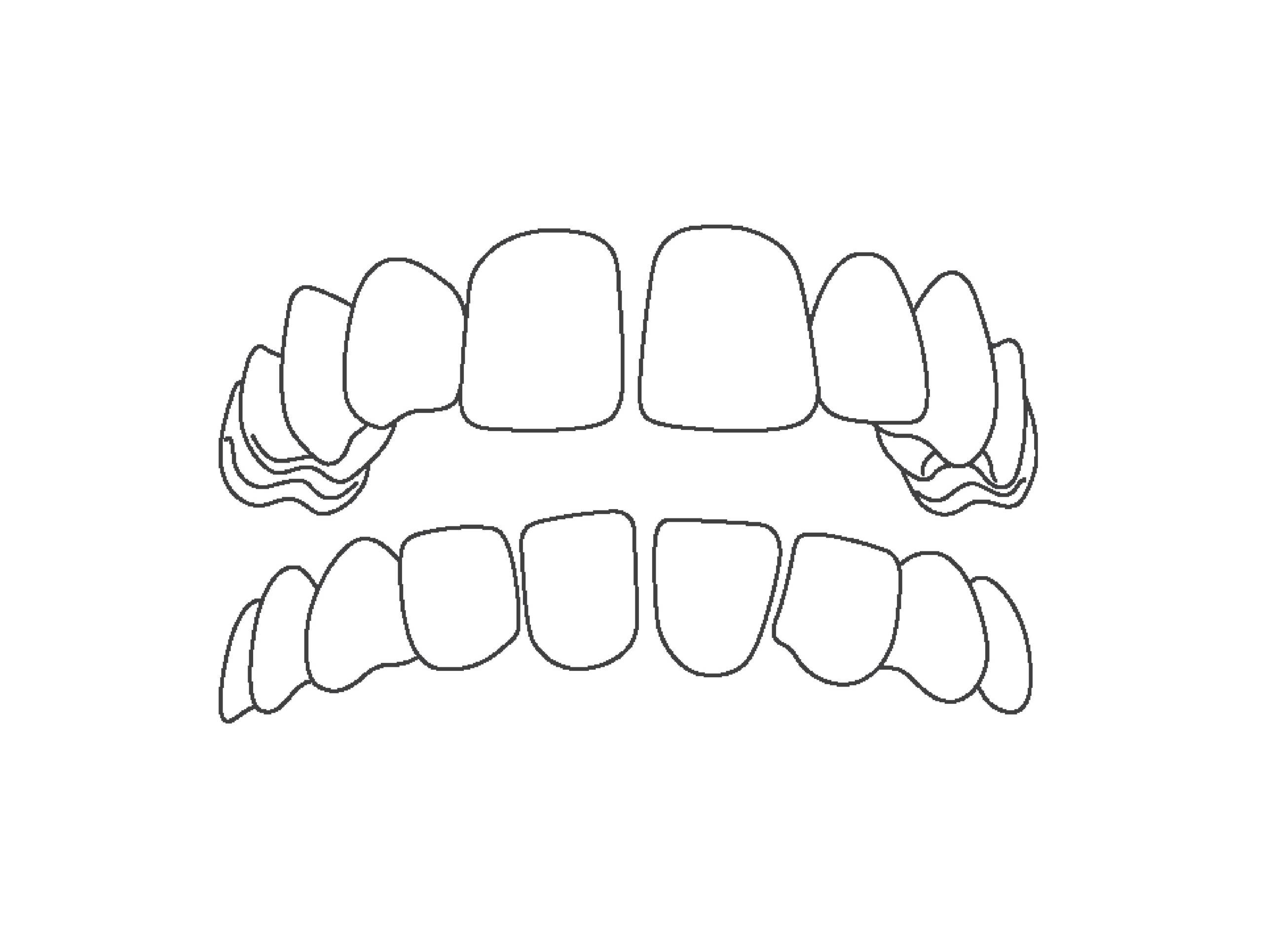 Line art of gapped teeth