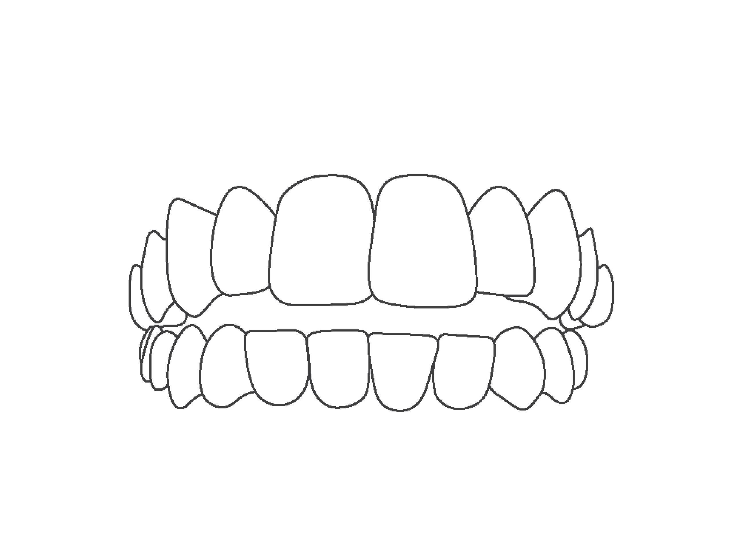 Line art of open bite