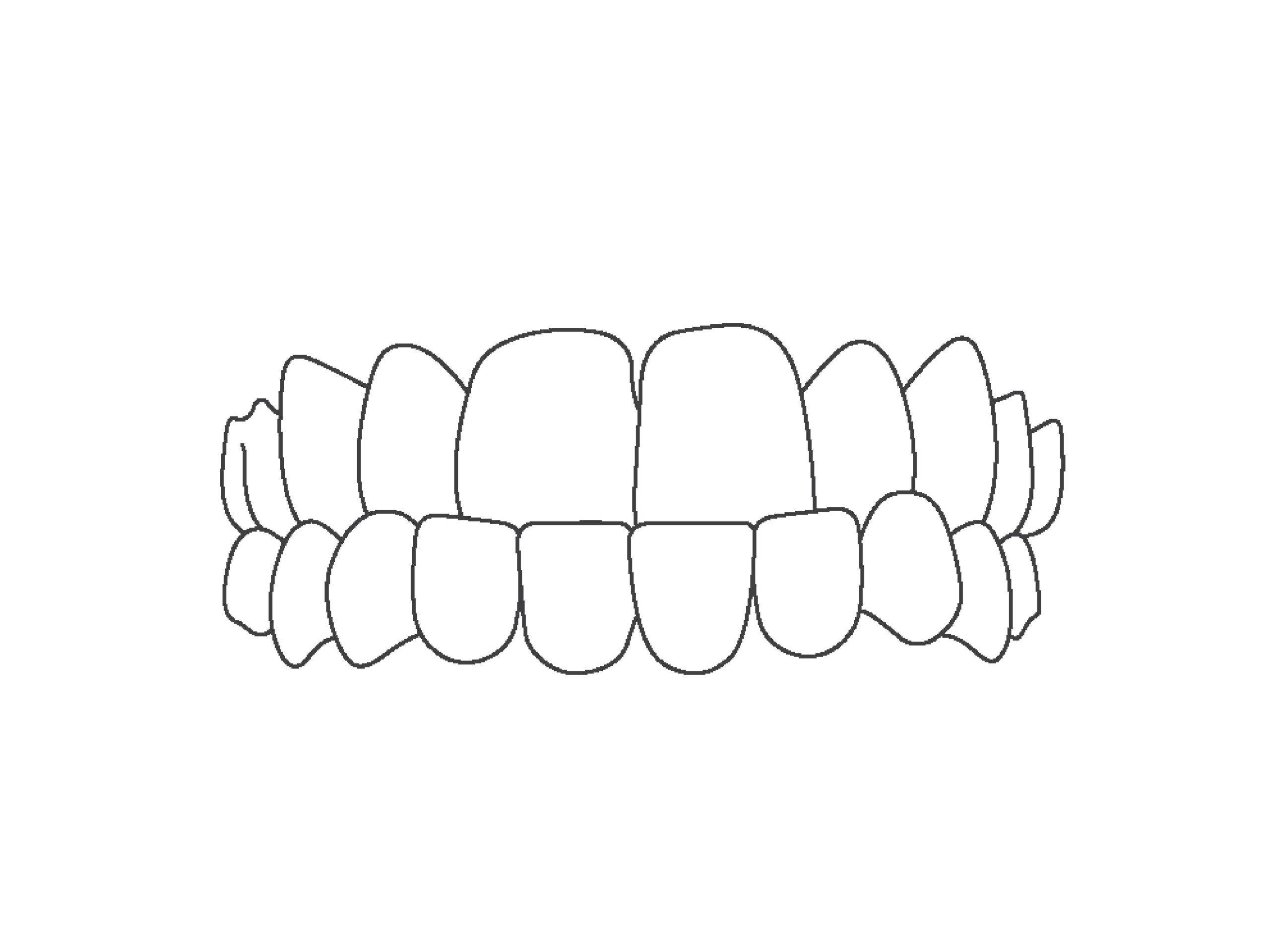 Line art of underbite