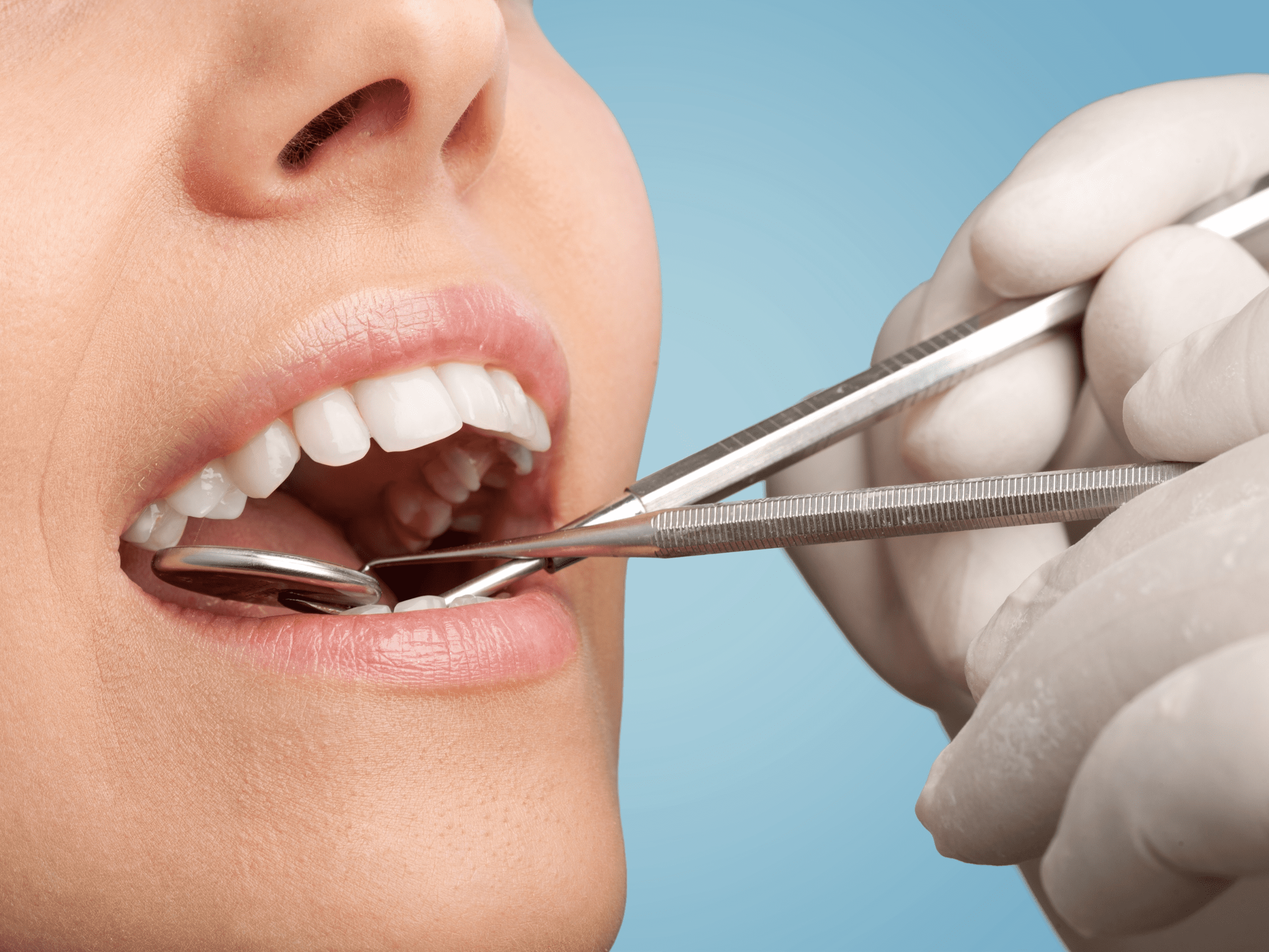 Dental Fillings