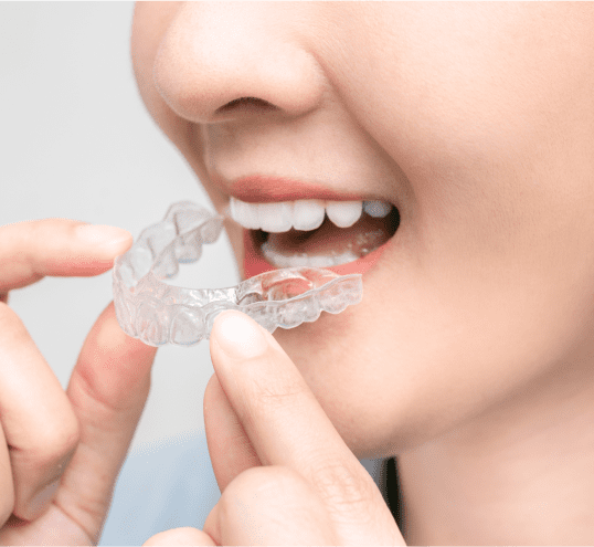 Clear Aligners Singapore