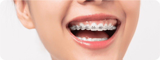 Close up image of a smile with braces on