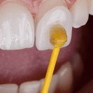 Composite Veneers