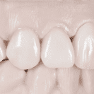 Porcelain Veneers