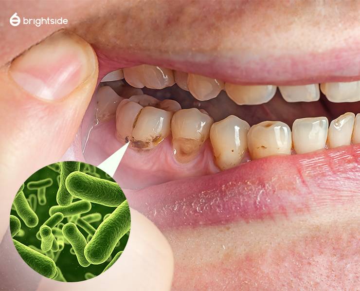 Bacteria in Mouth