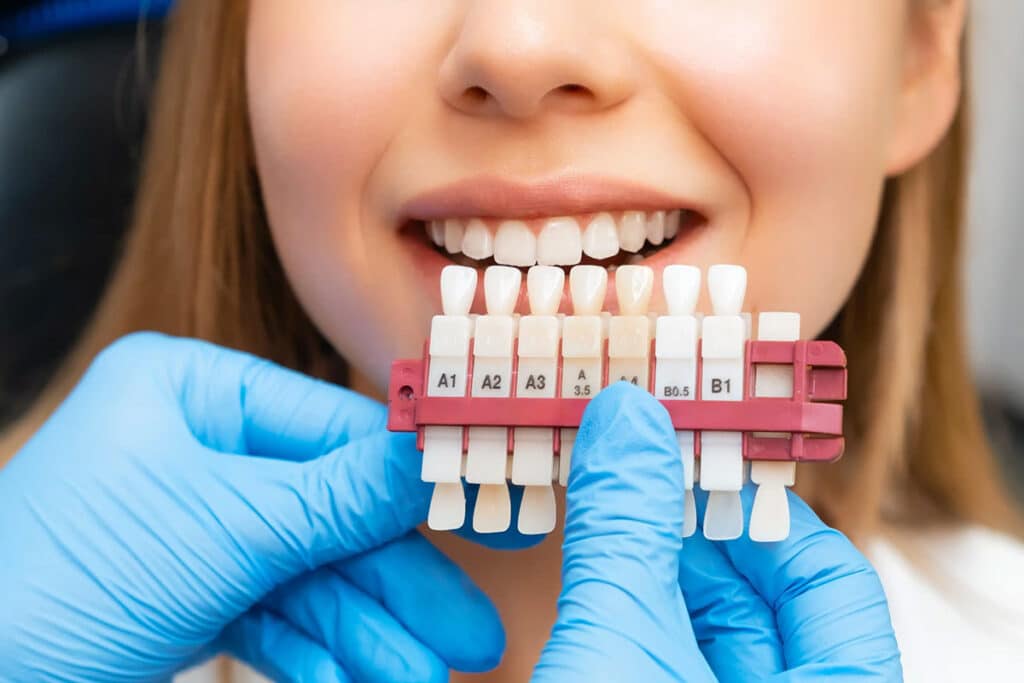 smile with various shades of teeth sample for teeth whitening in Singapore - Brightside Dental