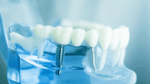 medical device dental implants stock