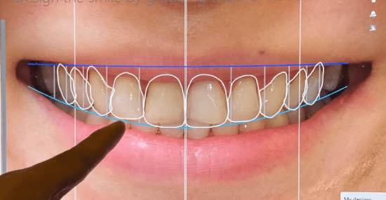 Veneer Process 1 - Design, Scan & Consult - Brightside Dental