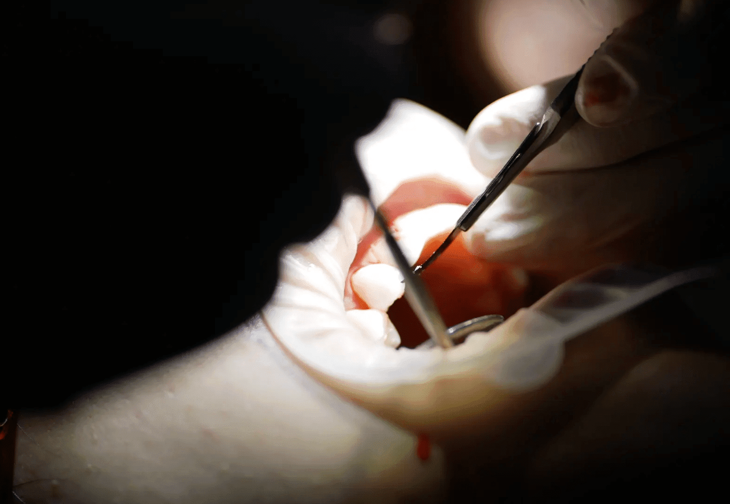 Dentist bonding a veneer to a patient’s tooth in Singapore - Brightside Dental