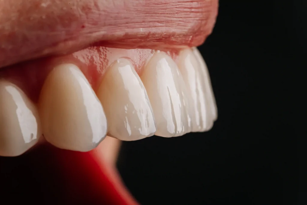 Porcelain veneers in Singapore - Brightside Dental