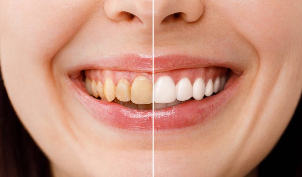 Comparison photo of stained teeth and white teeth of a woman smiling